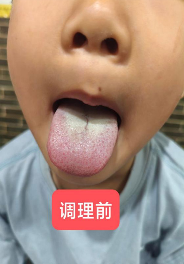 儿推师袁天好小儿积食医案-调理前